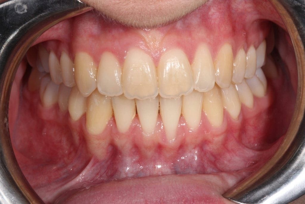 Lois Invisalign After