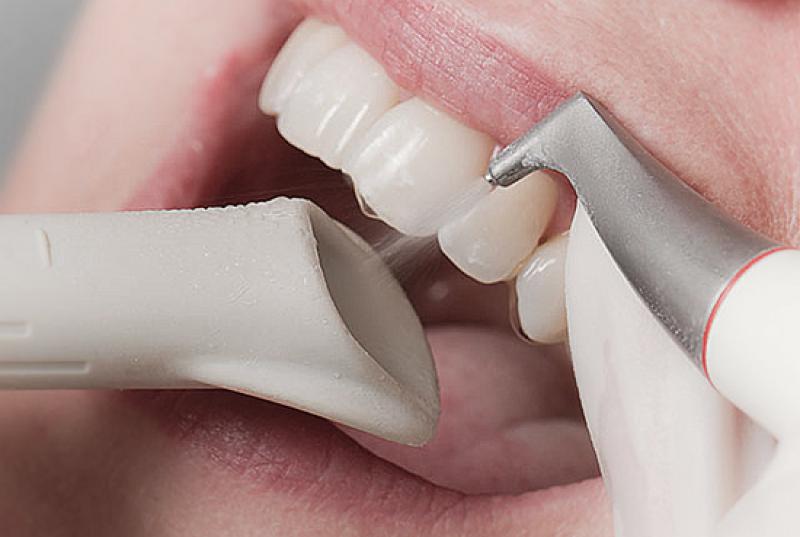 Air Flow Dentist technology for Teeth Whitening