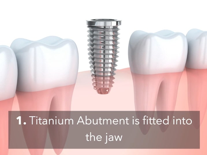 Dental Implant Process Video