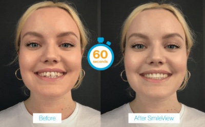 Invialign before and after with Smileview