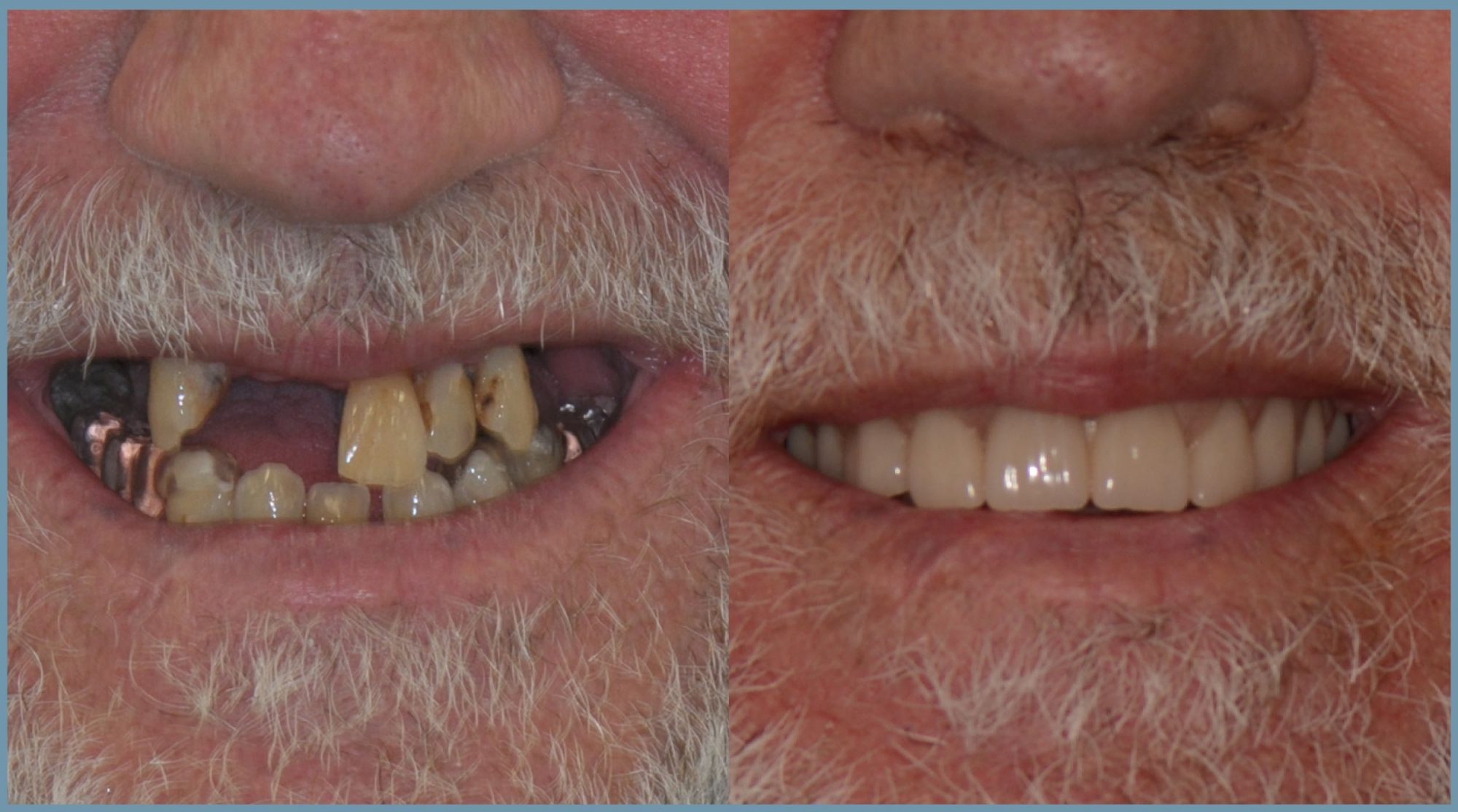 Nick Before and After Dental Implants