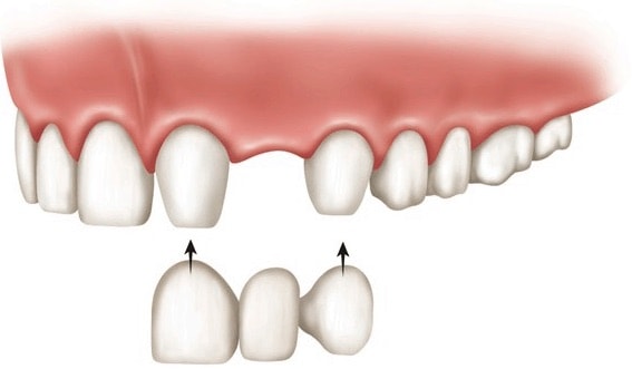 dental bridge